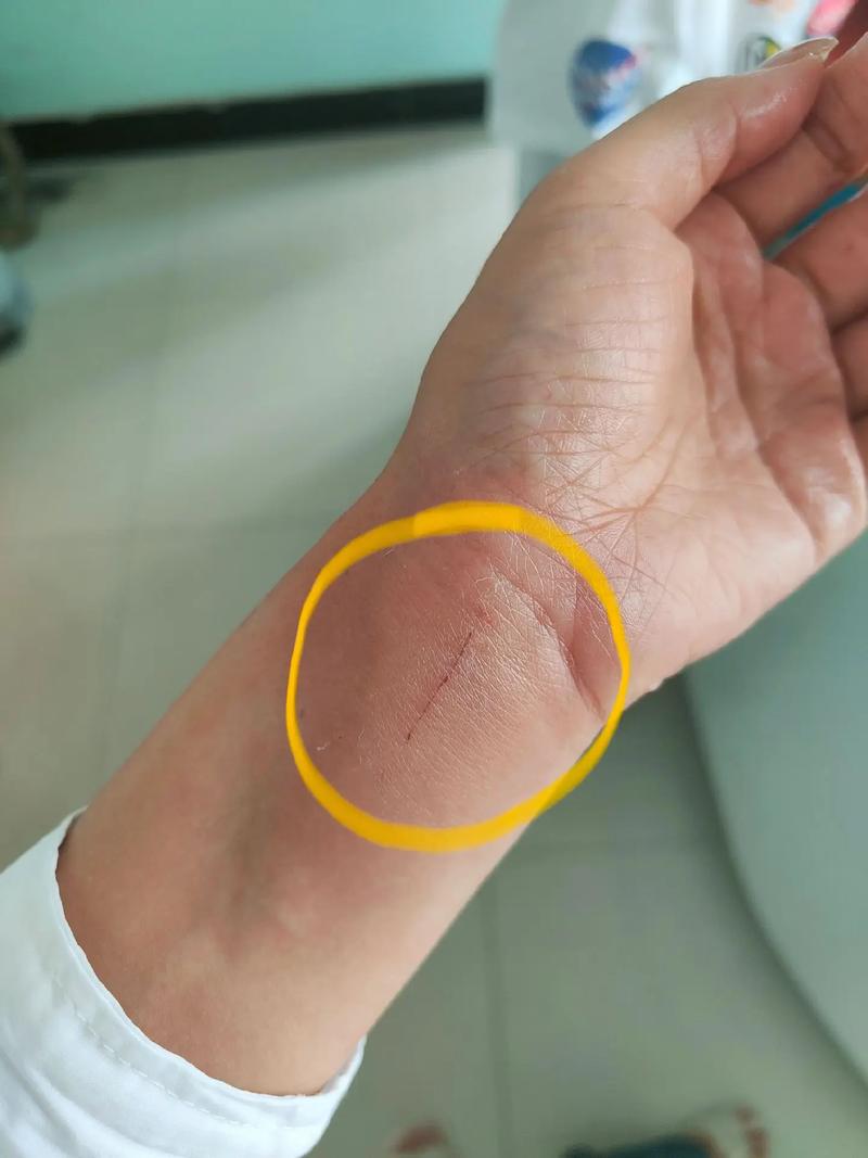 猫抓热,猫抓热会自愈吗-第5张图片 猫抓热,猫抓热会自愈吗-第5张图片