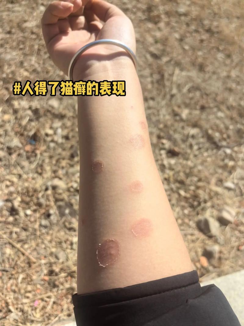 猫藓会人传人吗/猫藓会人传人吗?-第2张图片 猫藓会人传人吗/猫藓会人传人吗?-第2张图片