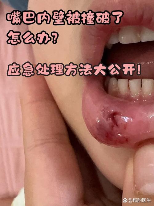 口咬/口咬的5个咬法视频-第2张图片 口咬/口咬的5个咬法视频-第2张图片