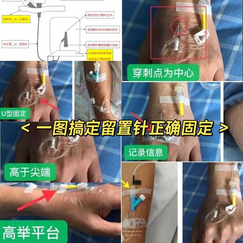 解析“留置针怎么拔”你不知道的事-第1张图片 解析“留置针怎么拔”你不知道的事-第1张图片