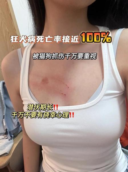 狂犬病的早期症状全身酸疼/狂犬病全身痛-第7张图片 狂犬病的早期症状全身酸疼/狂犬病全身痛-第7张图片