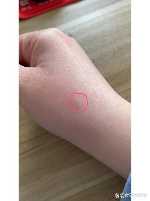 被猫咬破皮了需要打针吗，被猫咬破皮怎么办有必要打针
