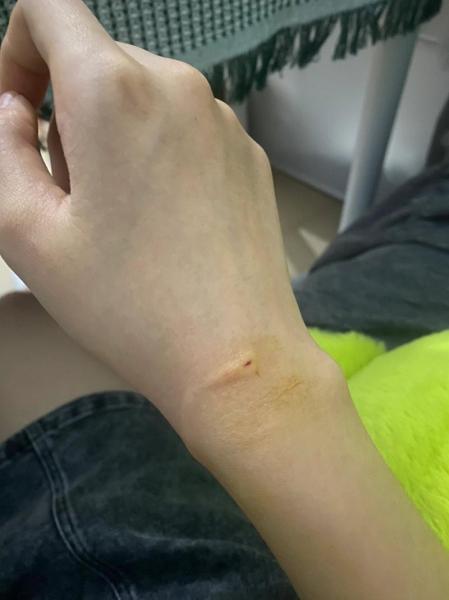 被猫咬破皮了需要打针吗,被猫咬破皮怎么办有必要打针-第4张图片 被猫咬破皮了需要打针吗,被猫咬破皮怎么办有必要打针-第4张图片