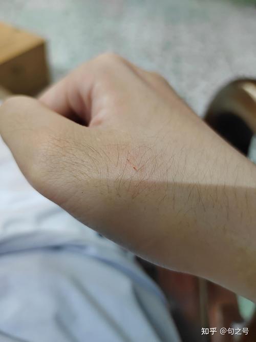 被猫咬破皮了需要打针吗,被猫咬破皮怎么办有必要打针-第5张图片 被猫咬破皮了需要打针吗,被猫咬破皮怎么办有必要打针-第5张图片